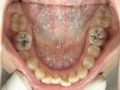 矯正歯科　治療後　下顎