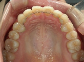 矯正歯科　治療後　上顎