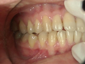 矯正歯科　治療後　右