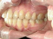 矯正歯科　治療後　左
