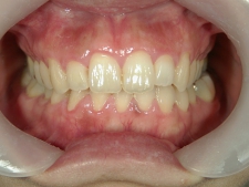 矯正歯科　アクアシステム（透明マウスピース矯正）　治療後