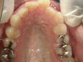 矯正歯科　治療前　上顎