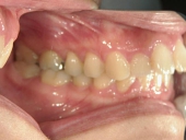 矯正歯科　治療前　右