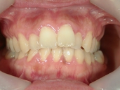 矯正歯科　治療前　正面