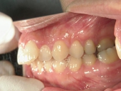 矯正歯科　治療前　左