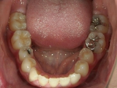 矯正歯科　治療前　下顎