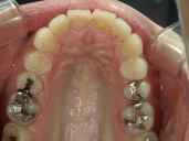 矯正歯科　治療後　上顎