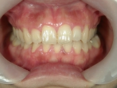 矯正歯科　治療後　正面