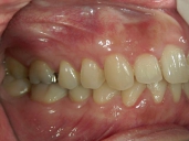 矯正歯科　治療後　右