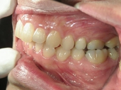 矯正歯科　治療後　左