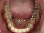 矯正歯科　治療後　下顎