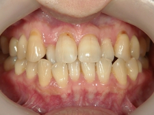 矯正歯科　治療前