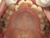 矯正歯科　治療前　上顎