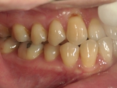 矯正歯科　治療前　右