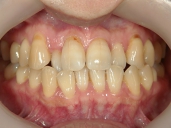 矯正歯科　治療前　正面