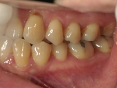 矯正歯科　治療前　左