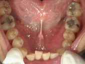 矯正歯科　治療前　下顎