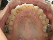 矯正歯科　治療後　上顎