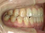 矯正歯科　治療後　右