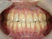 矯正歯科　治療後　正面