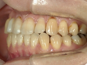 矯正歯科　治療後　左