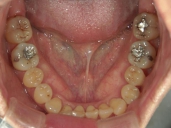 矯正歯科　治療後　下顎