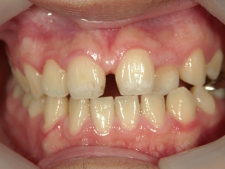 矯正歯科　治療後