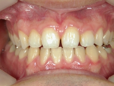 矯正歯科　アクアシステム（透明マウスピース矯正）　治療後