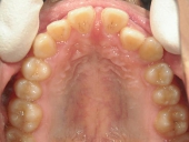 矯正歯科　治療前　上顎