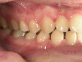 矯正歯科　治療前　右