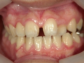 矯正歯科　治療前　正面