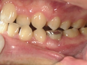 矯正歯科　治療前　左