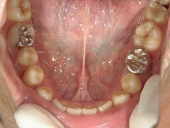 矯正歯科　治療前　下顎