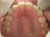 矯正歯科　治療後　上顎