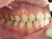 矯正歯科　治療後　右