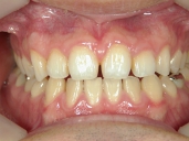 矯正歯科　治療後　正面