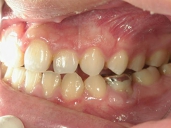 矯正歯科　治療後　左