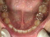 矯正歯科　治療後　下顎