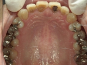 矯正歯科　治療前　上顎