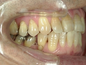 矯正歯科　治療前　右