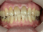 矯正歯科　治療前　正面