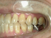 矯正歯科　治療前　左