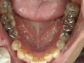 矯正歯科　治療前　下顎