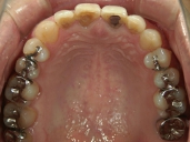 矯正歯科　治療後　上顎