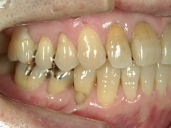 矯正歯科　治療後　右