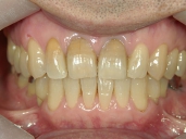 矯正歯科　治療後　正面