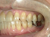 矯正歯科　治療後　左