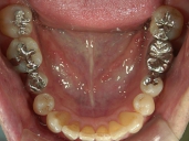 矯正歯科　治療後　下顎