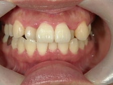 矯正歯科　治療前