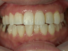 矯正歯科　アクアシステム（透明マウスピース矯正）　プチワイヤー矯正　治療後